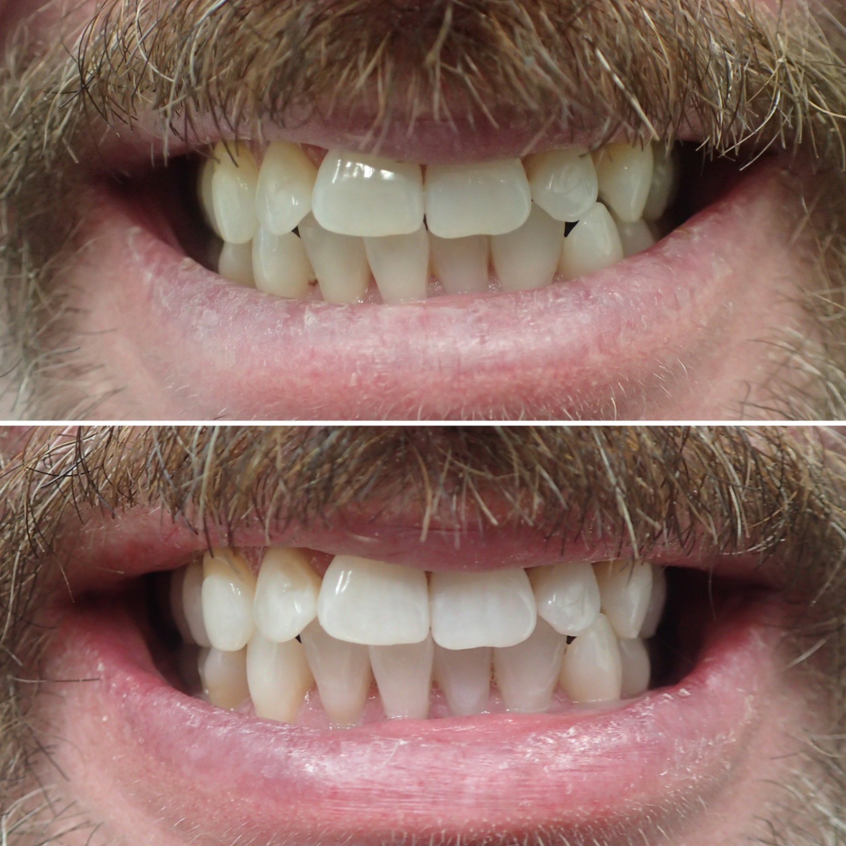 Teeth whitening before and after