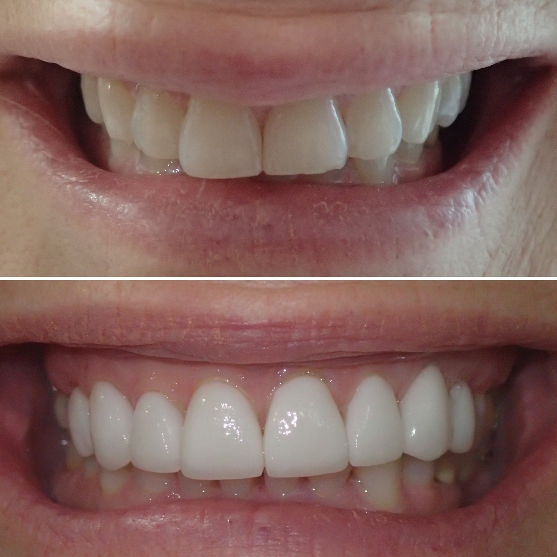 Veneers before and after