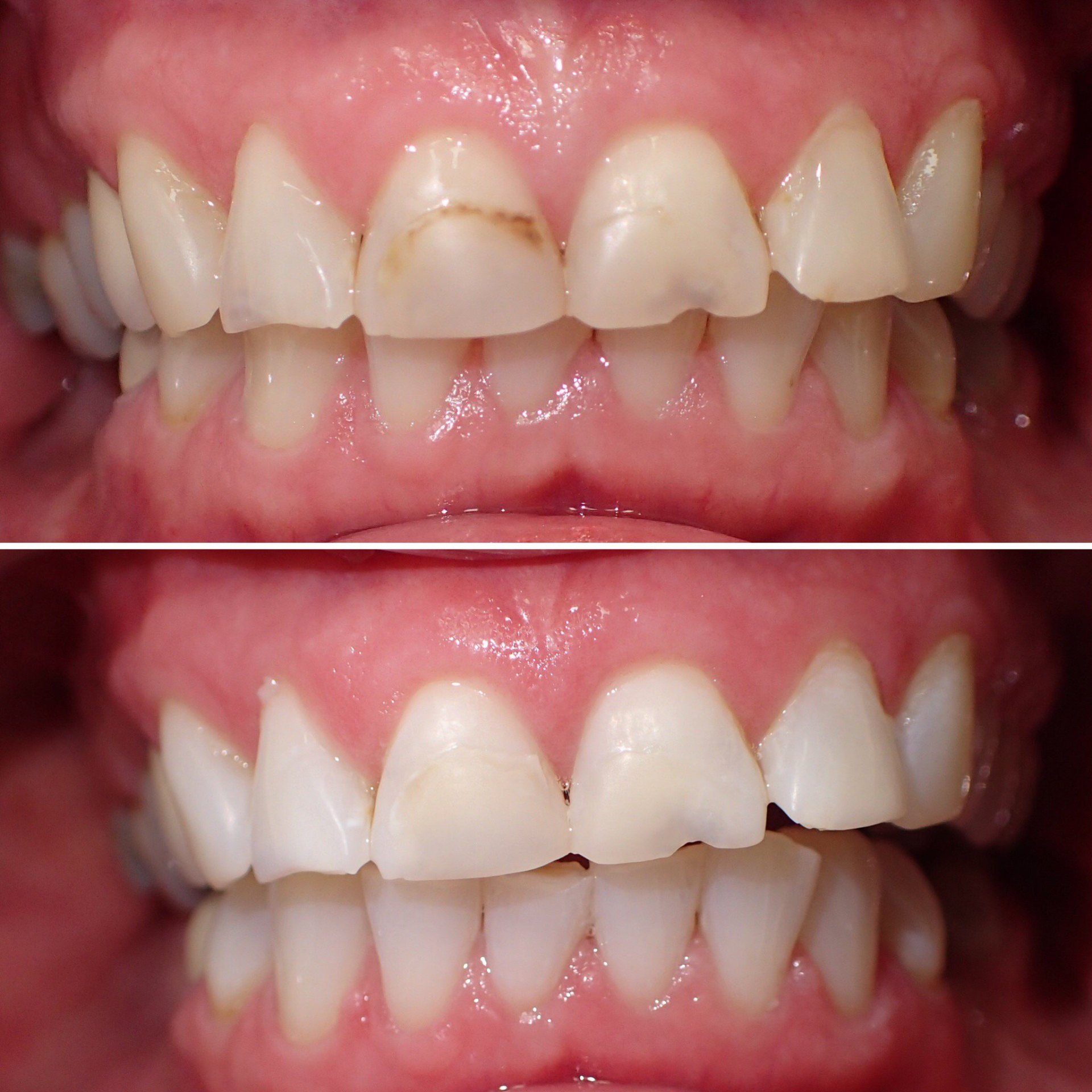 Teeth whitening before and after