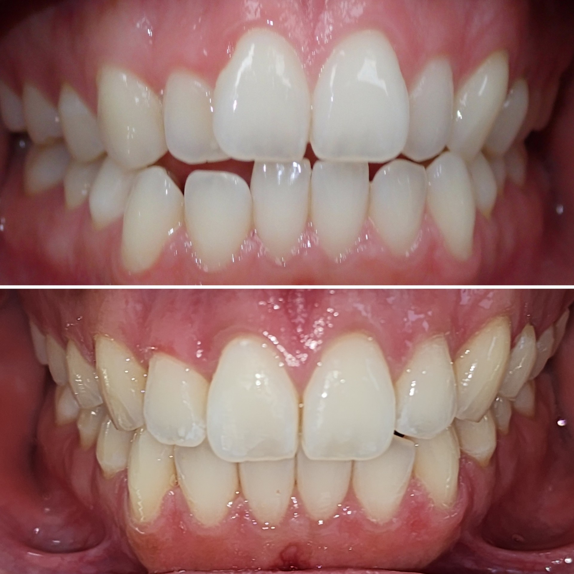 Invisalign before and after