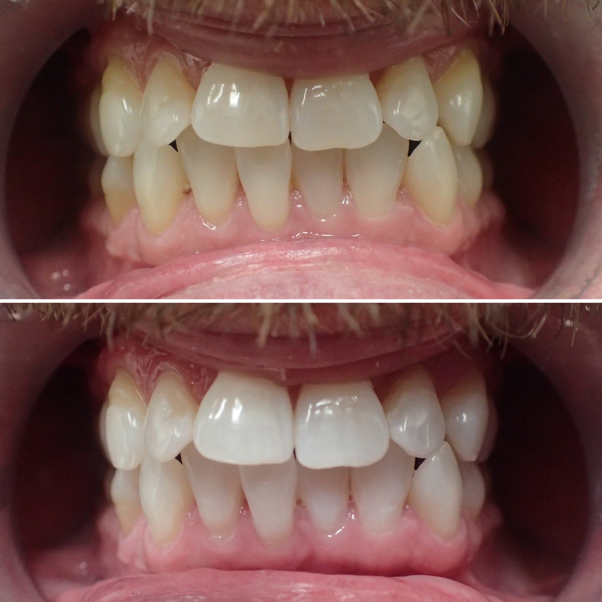 Teeth whitening before and after