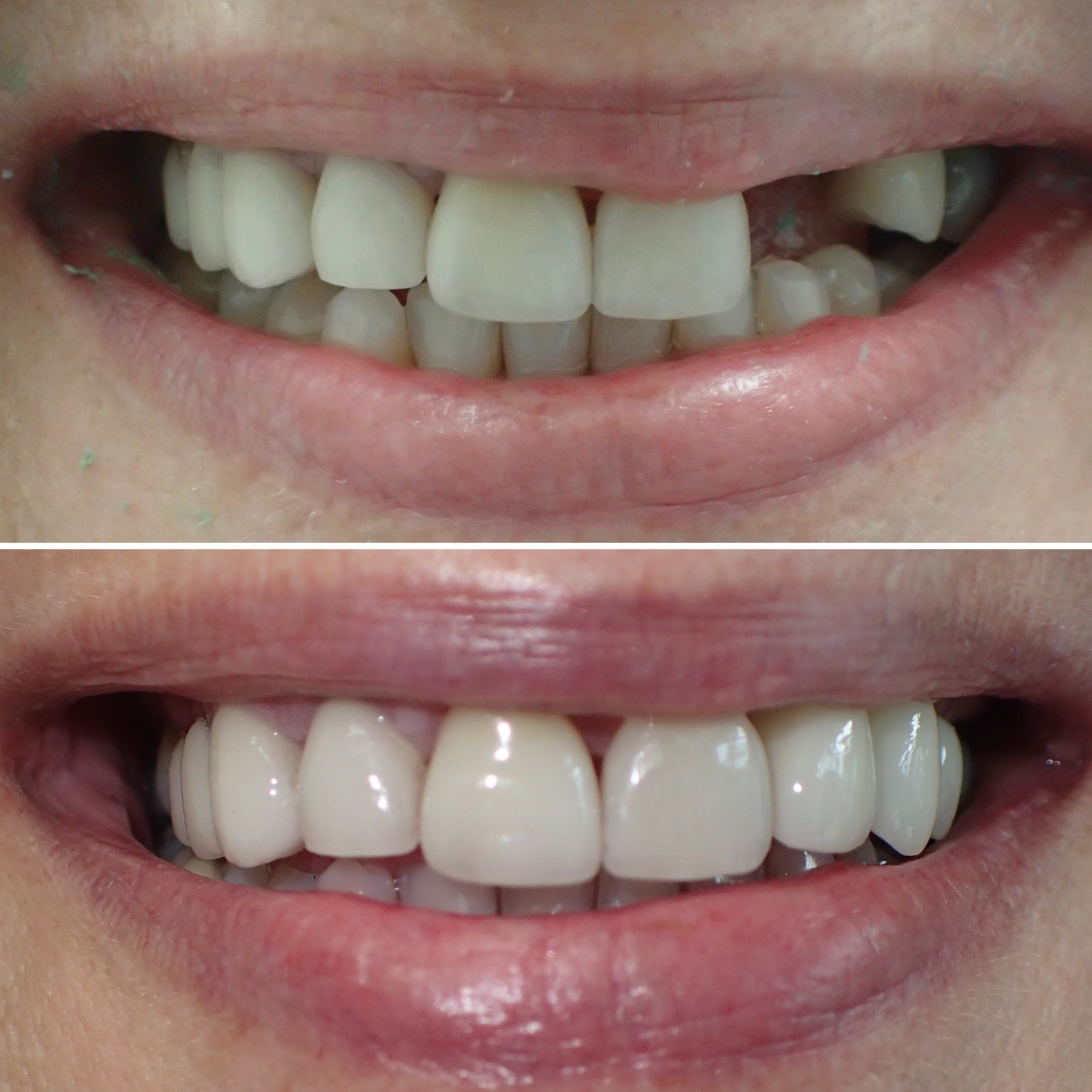 Dental Implants before and after