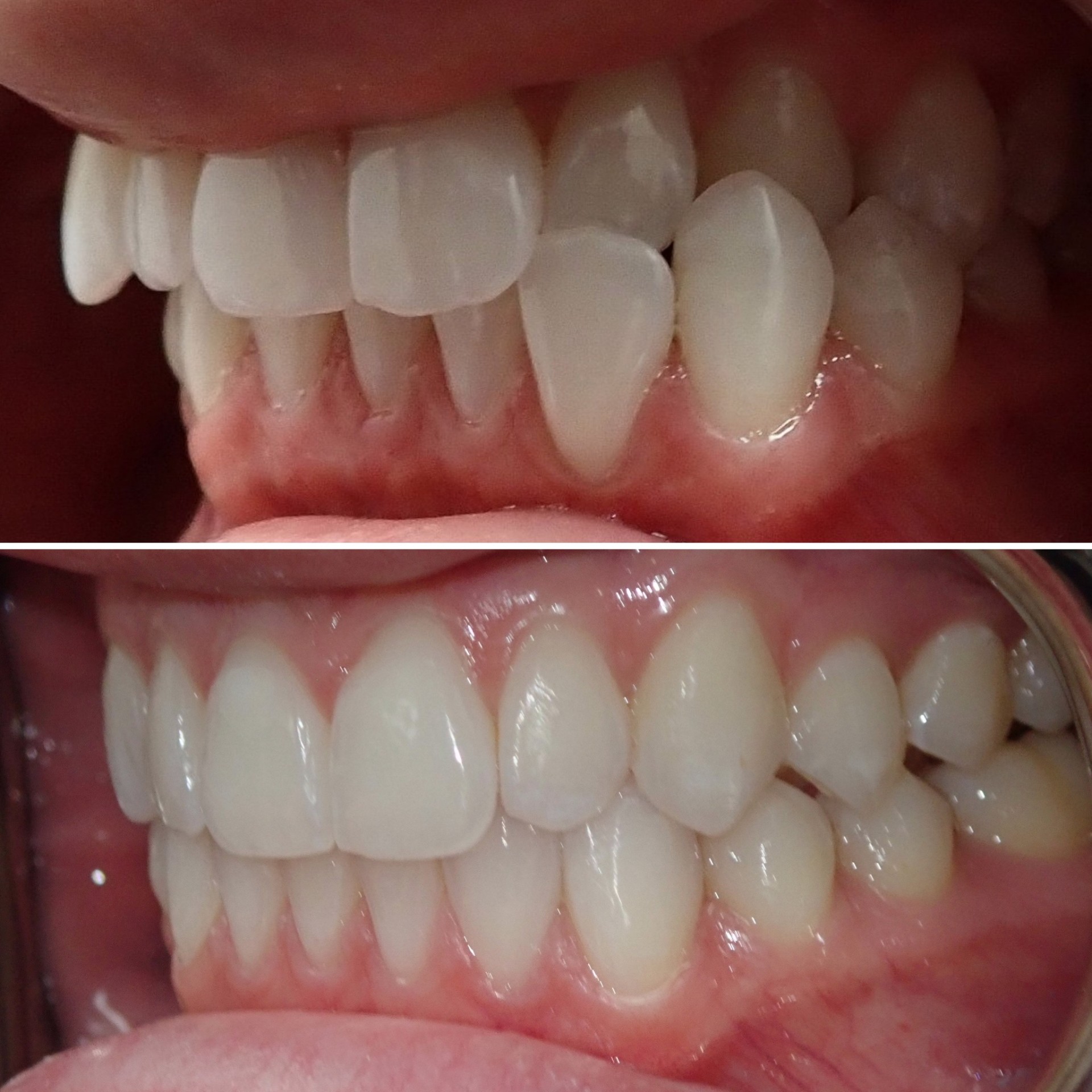 Invisalign before and after