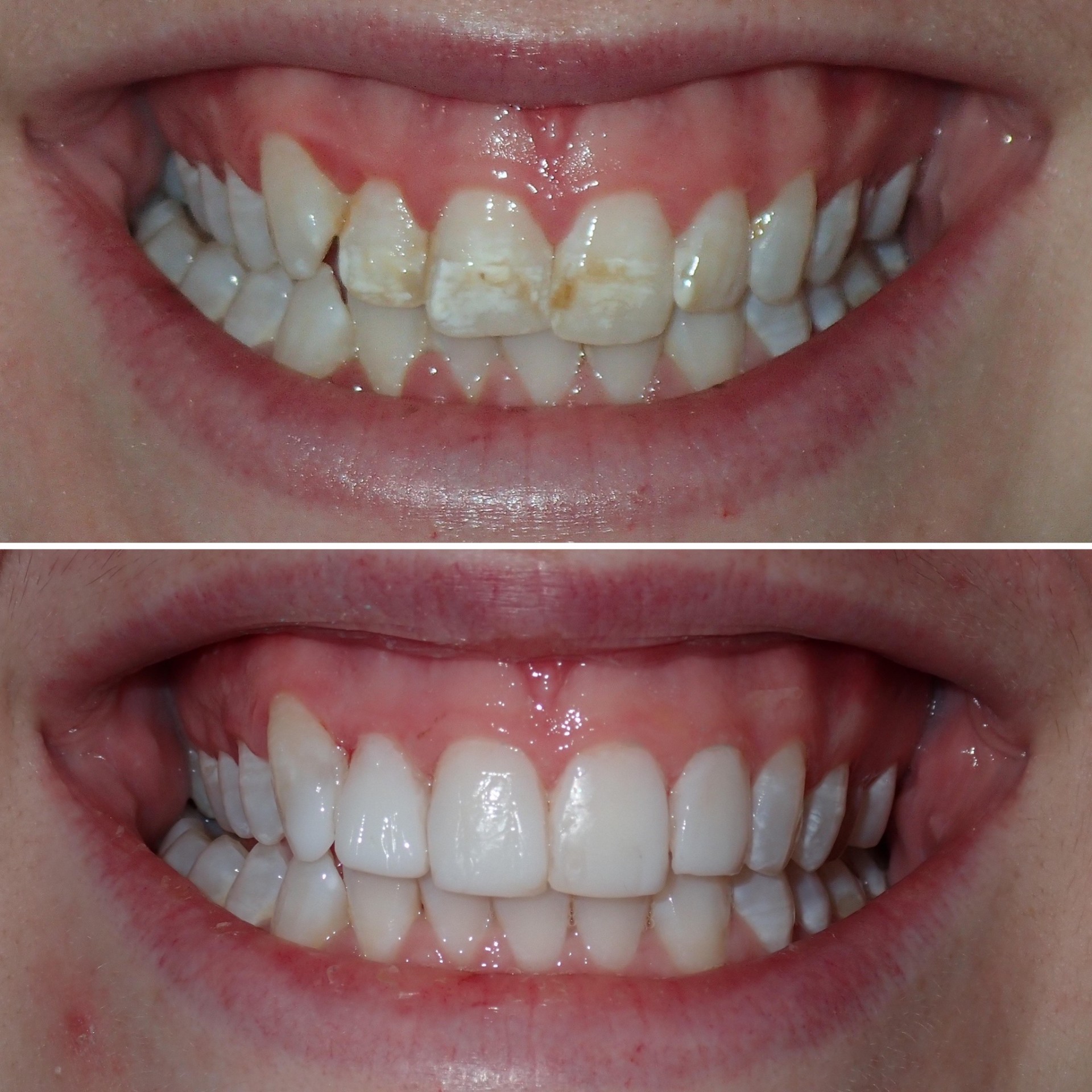 Veneers before and after