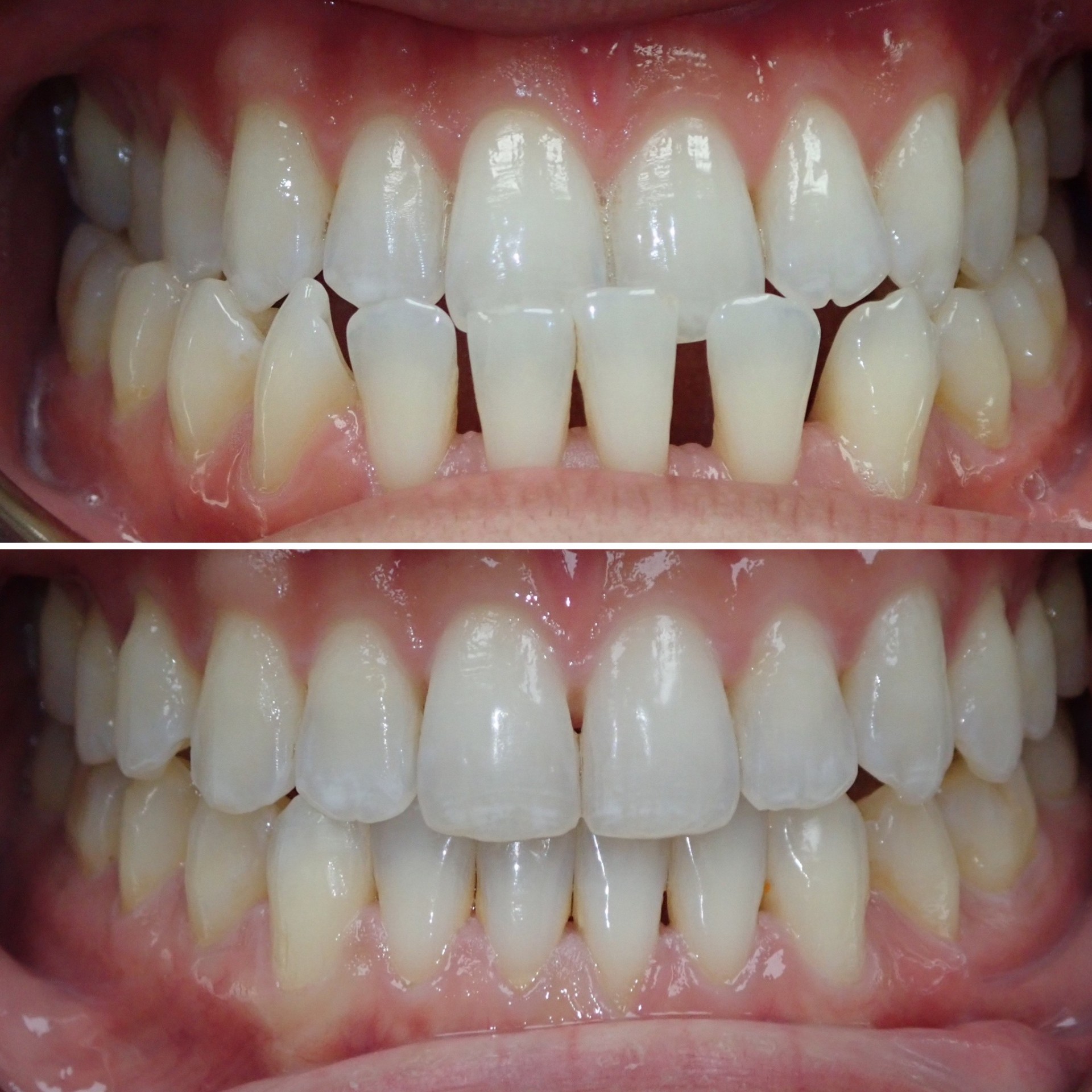 Invisalign before and after