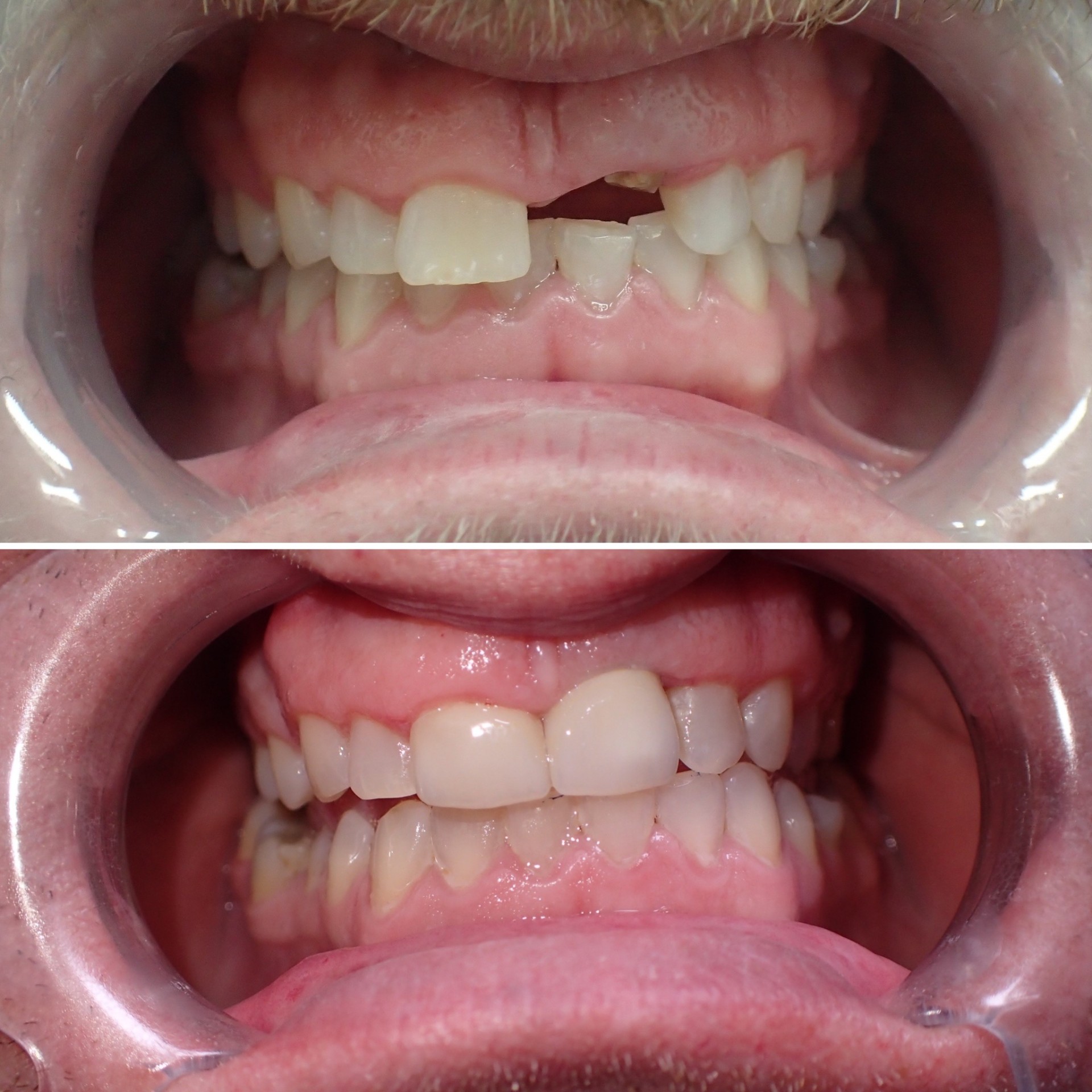 Dental Implants before and after