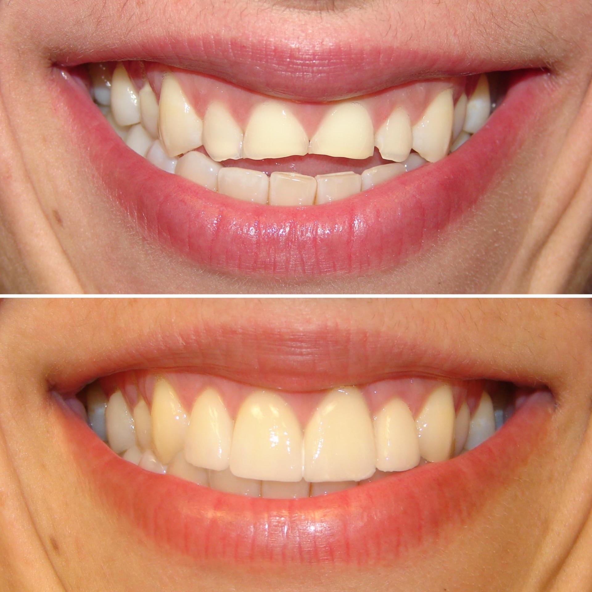 Veneers before and after