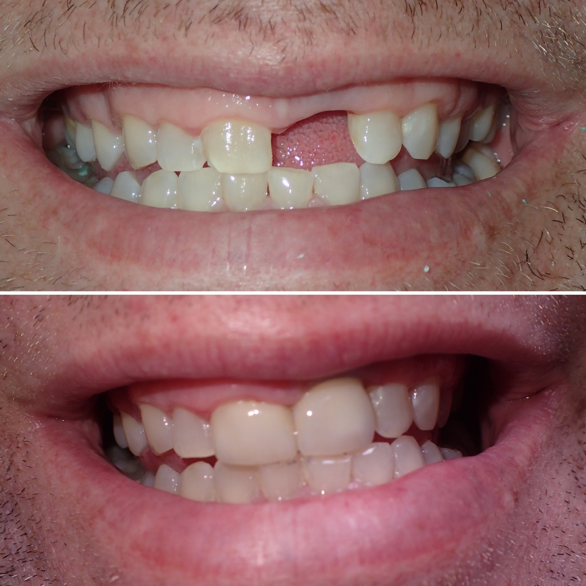 Dental Implants before and after